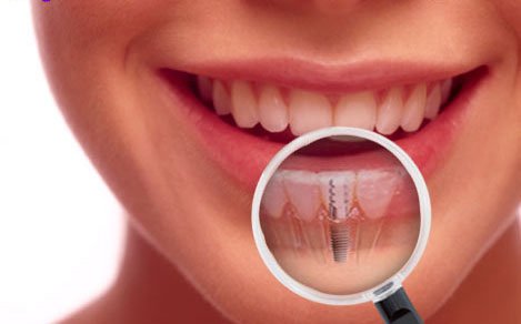 Dental Implants at Smiling Oak Dentistry