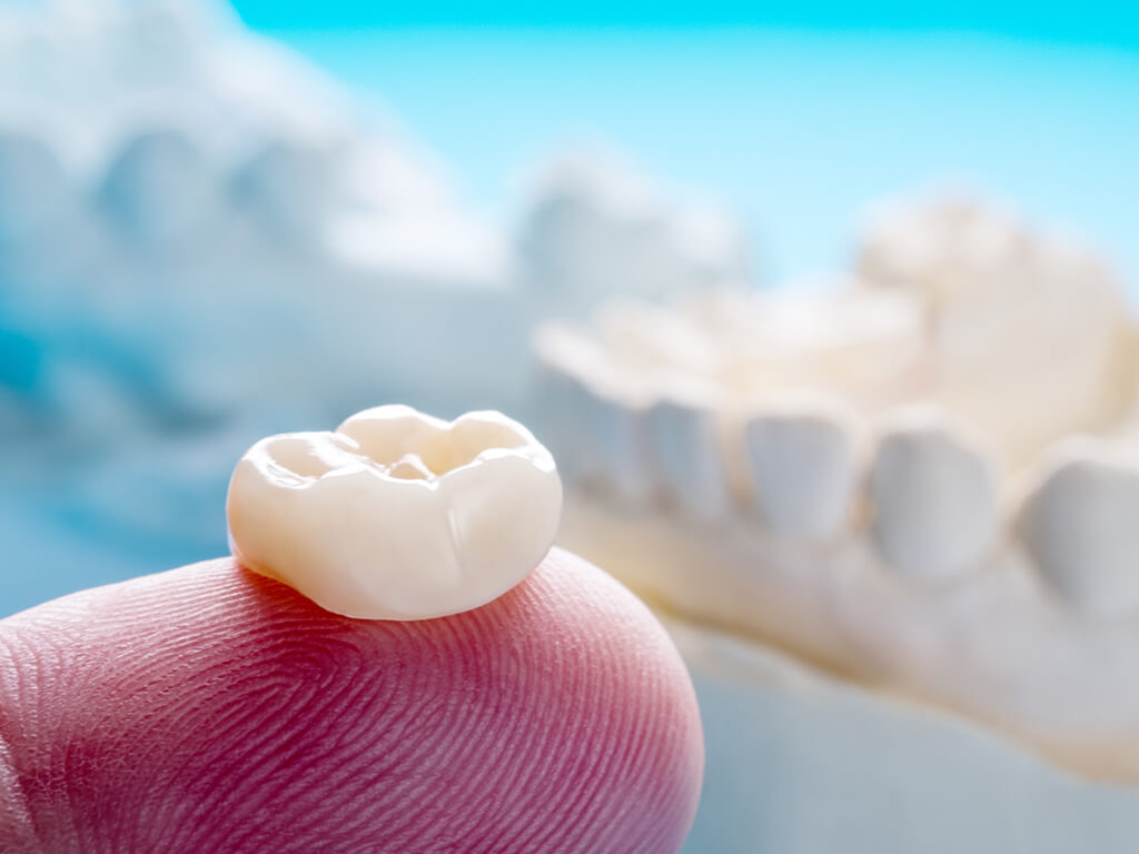 Same-Day Crowns at Smiling Oak Dentistry