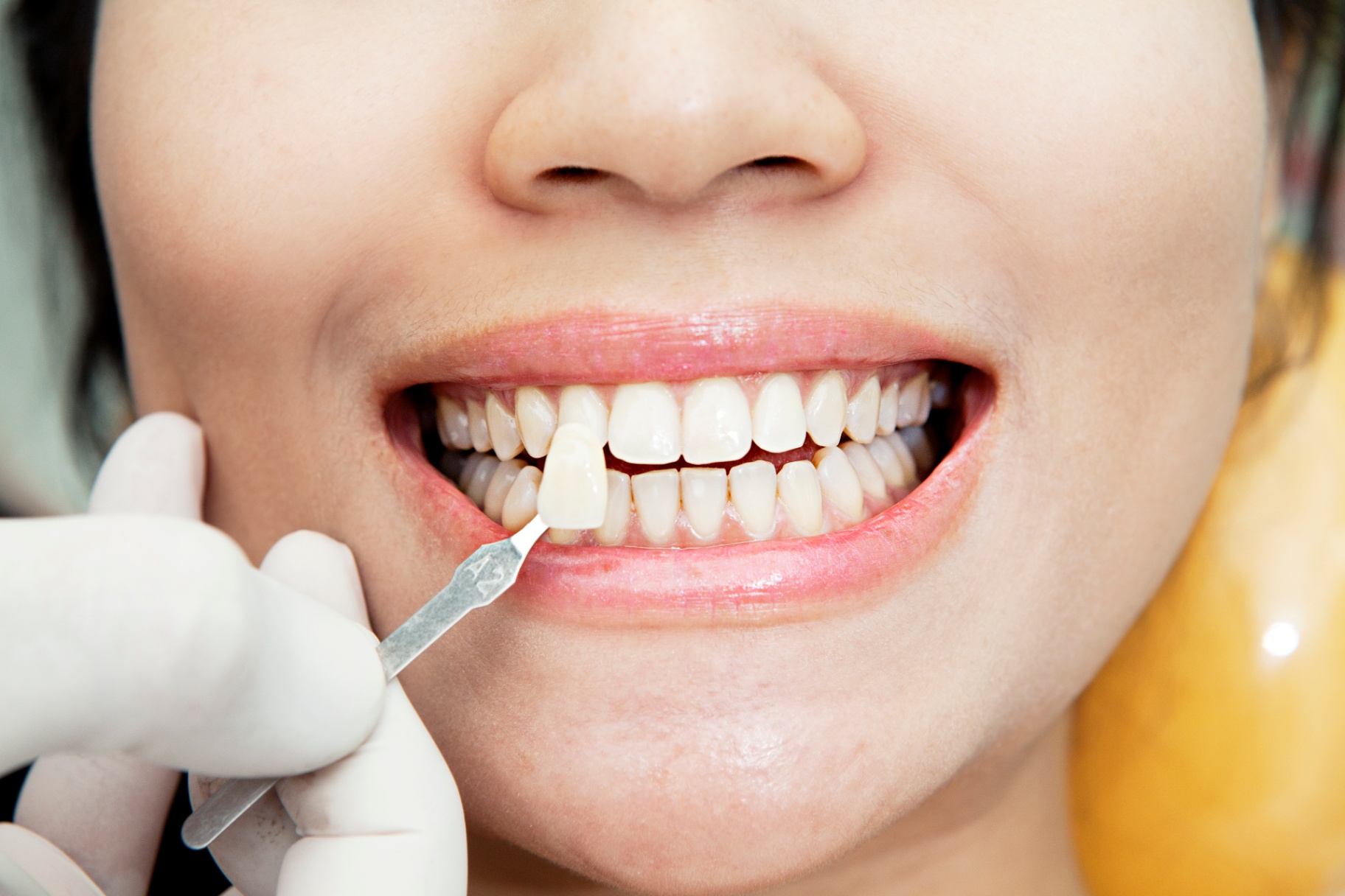 Porcelain Veneers at Smiling Oak Dentistry