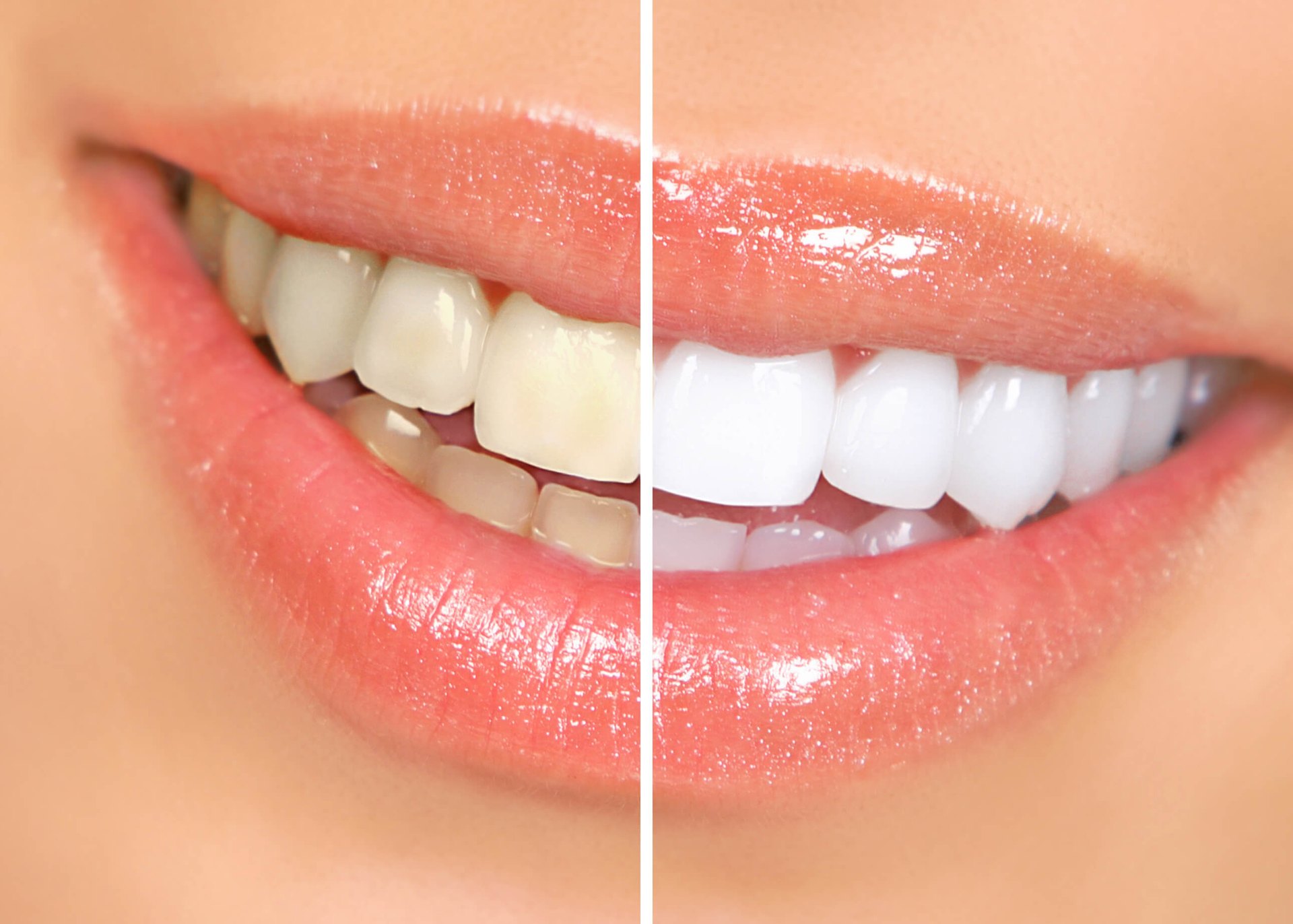 Teeth Whitening at Smiling Oak Dentistry